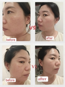 Before and after results using red light therapy mask
