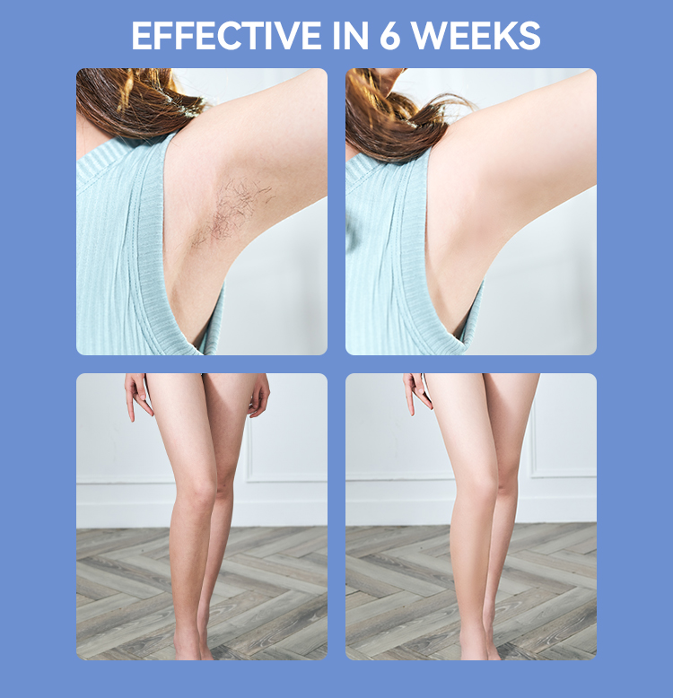 SKB-2110 Home-Use IPL Hair Removal Device